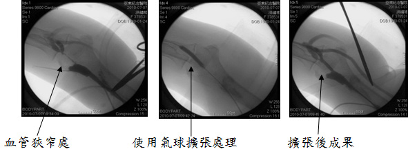 動靜脈瘻管手術