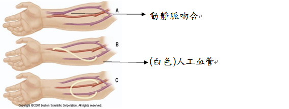 動靜脈瘻管手術