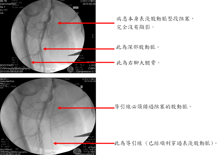 週邊動脈疾病結合內科與外科治療
