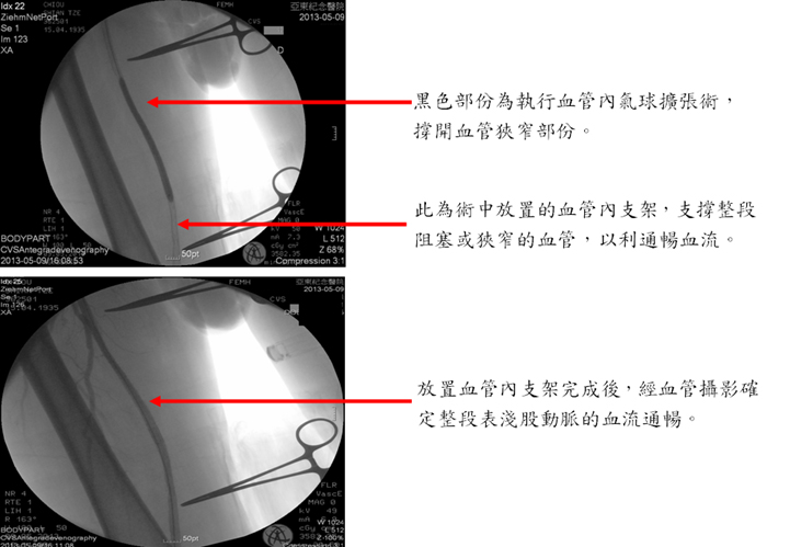 週邊動脈疾病結合內科與外科治療