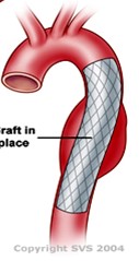 stent graft_SVS